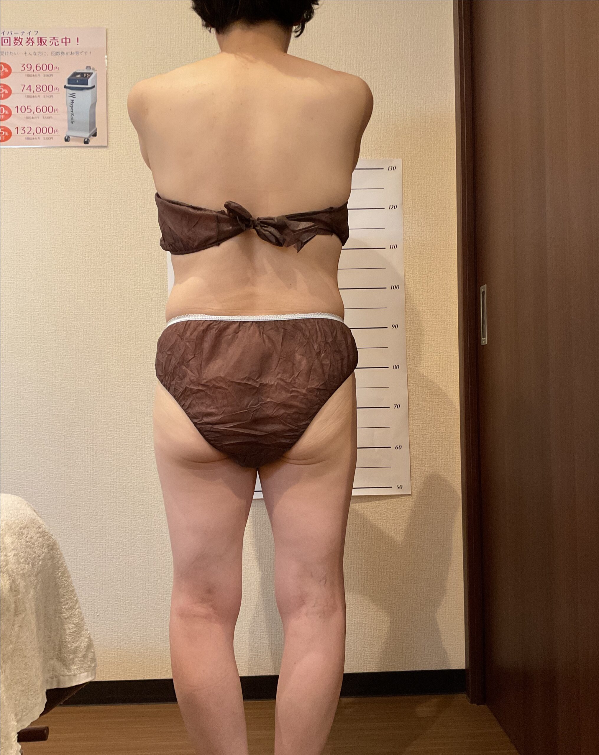 CASE02 施術前 背面